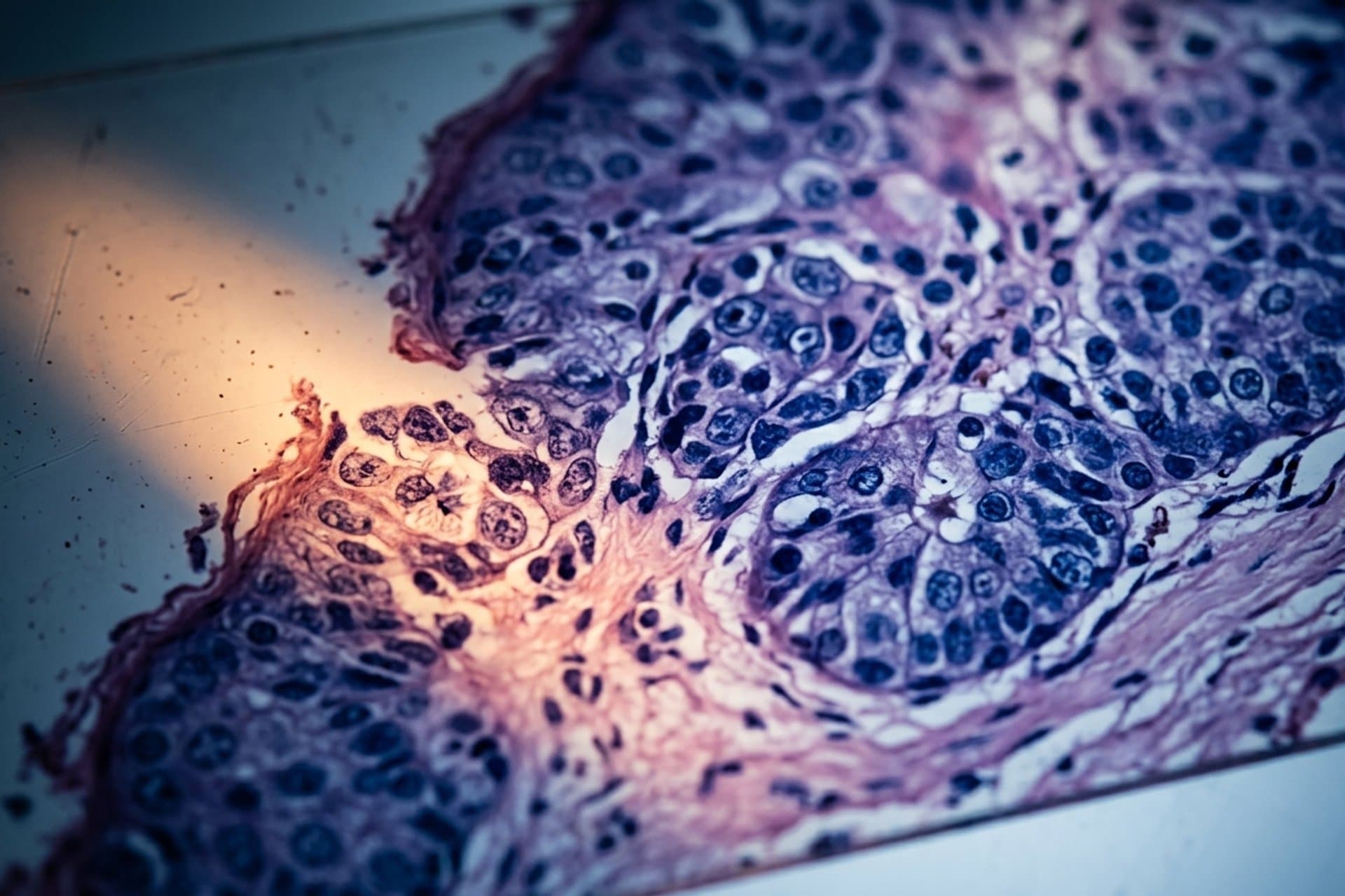 Bösartige Neubildungen des Zahnfleisches — medizin.studio
