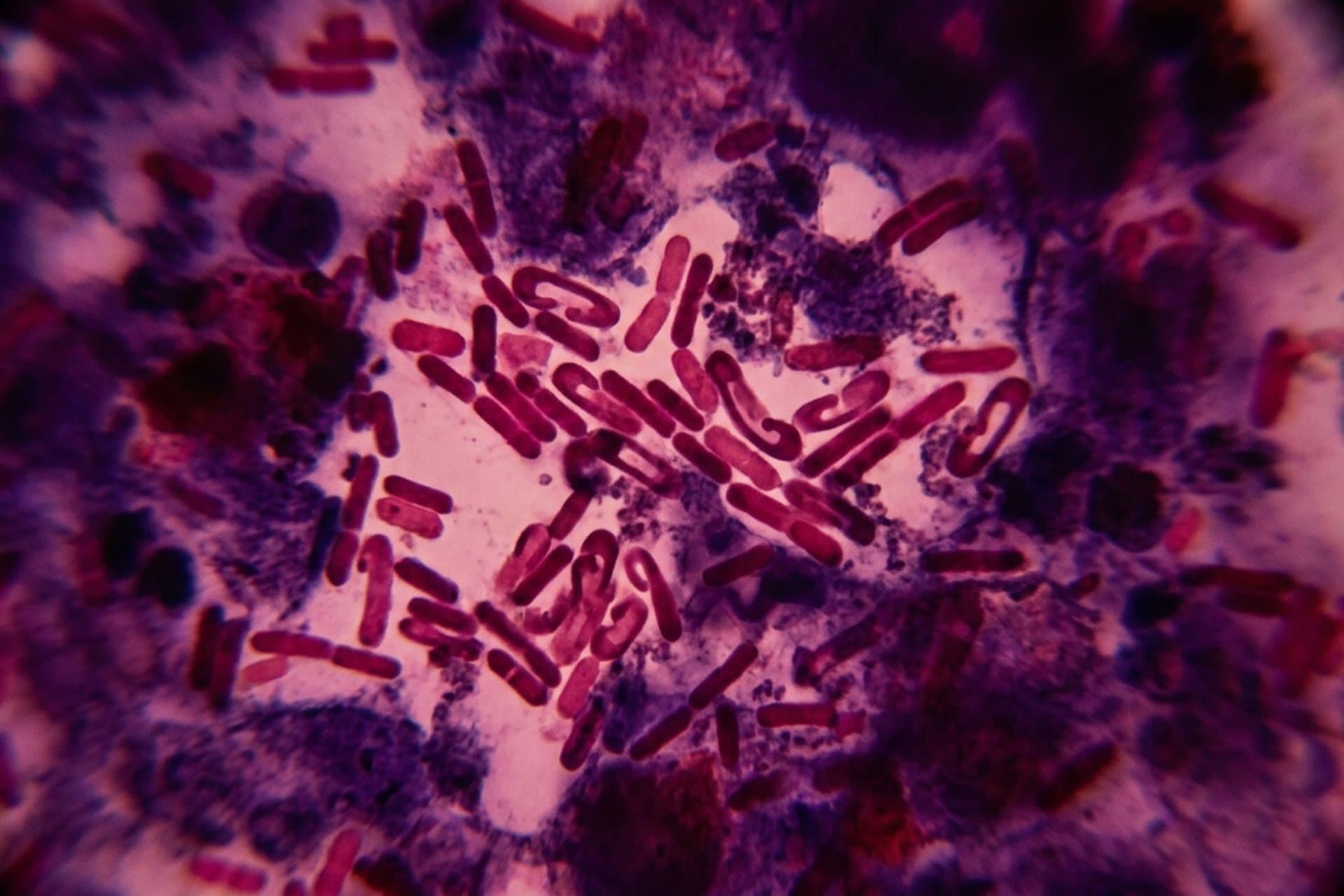 Beulenpest — medizin.studio
