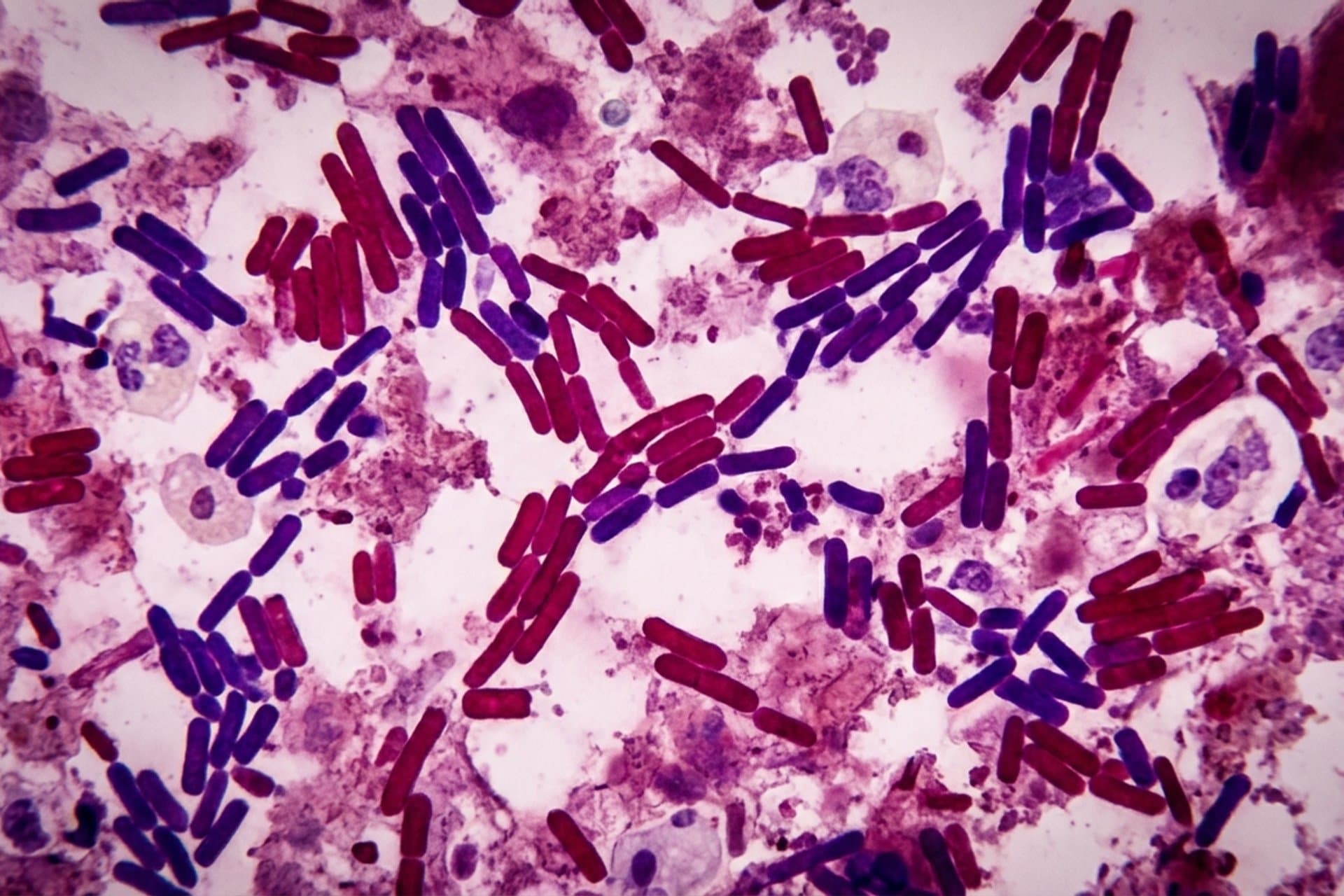 Infektionen, die durch andere Mykobakterien verursacht werden — medizin.studio