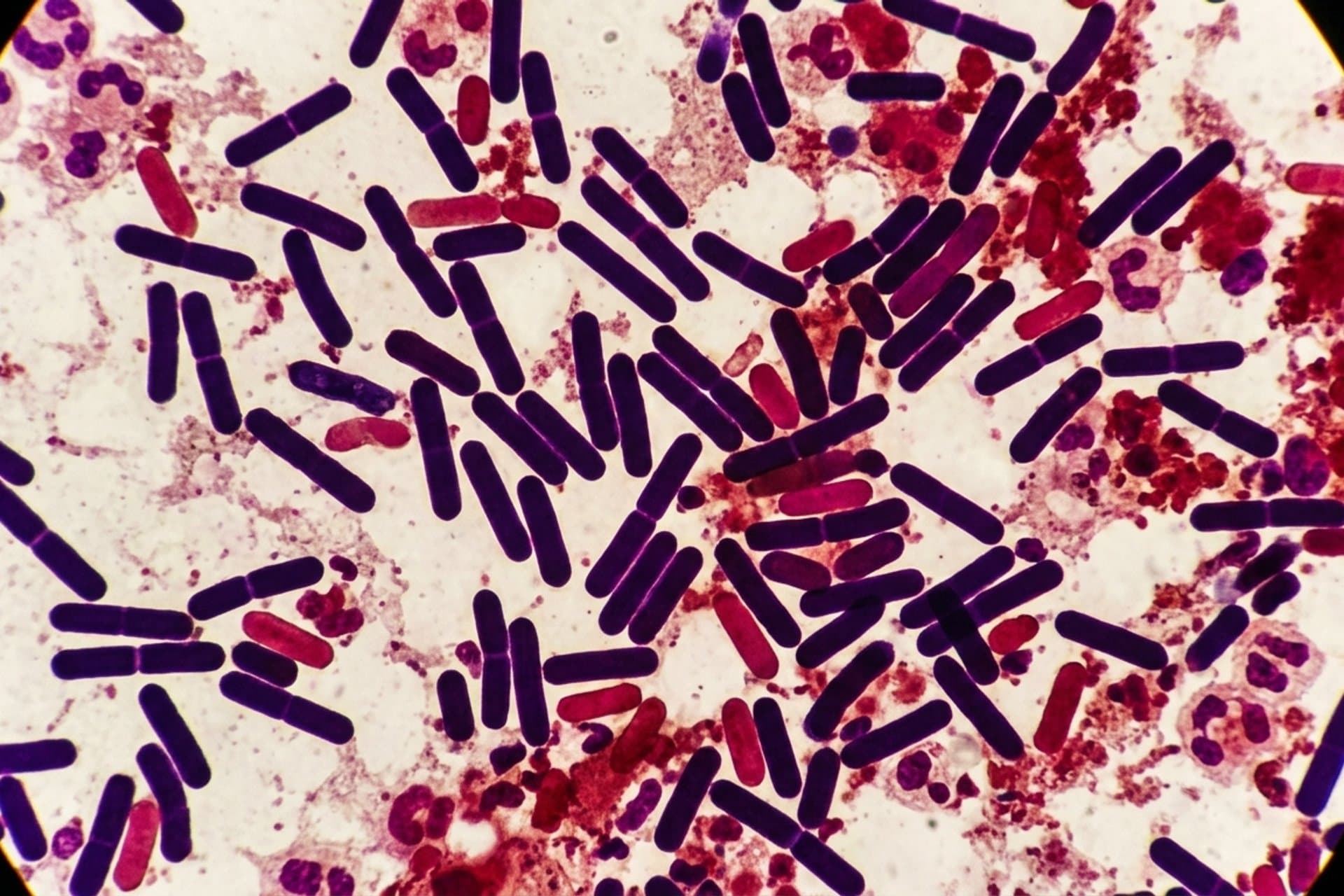 Lebensmittelvergiftung durch Clostridium perfringens — medizin.studio