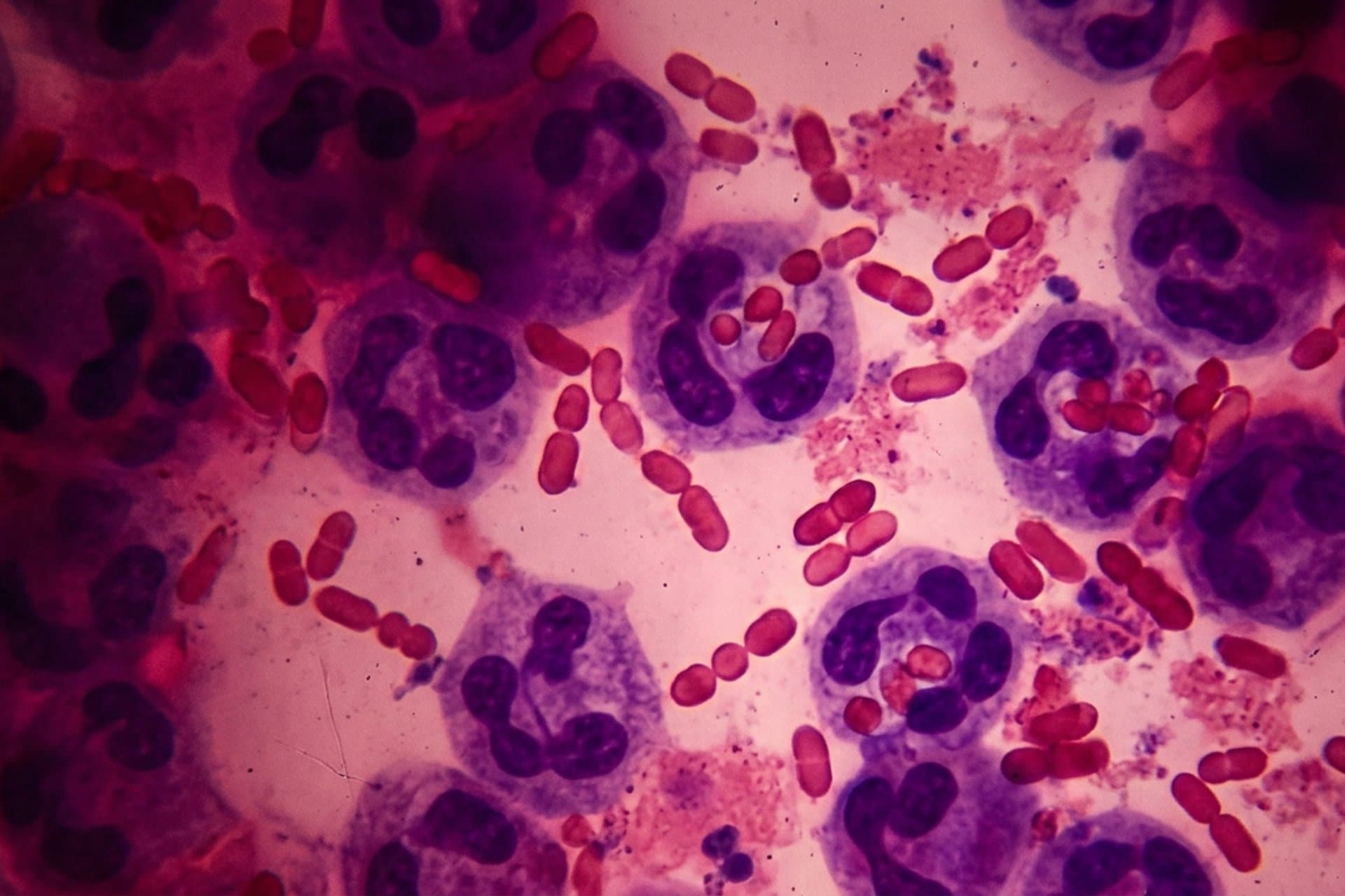 Meningitis bei bakteriellen Erkrankungen, die anderswo klassifiziert werden — medizin.studio