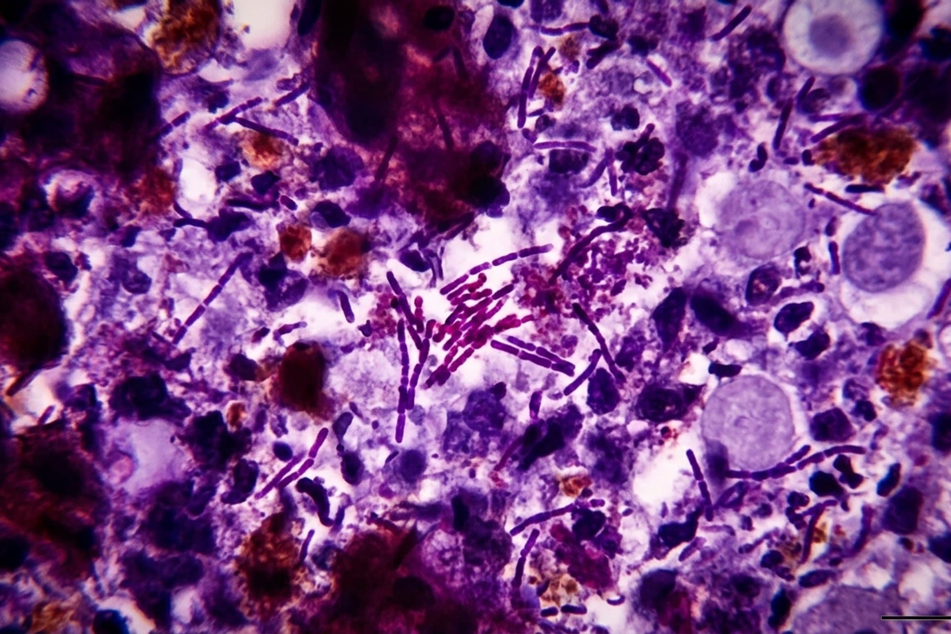 Miliartuberkulose — medizin.studio