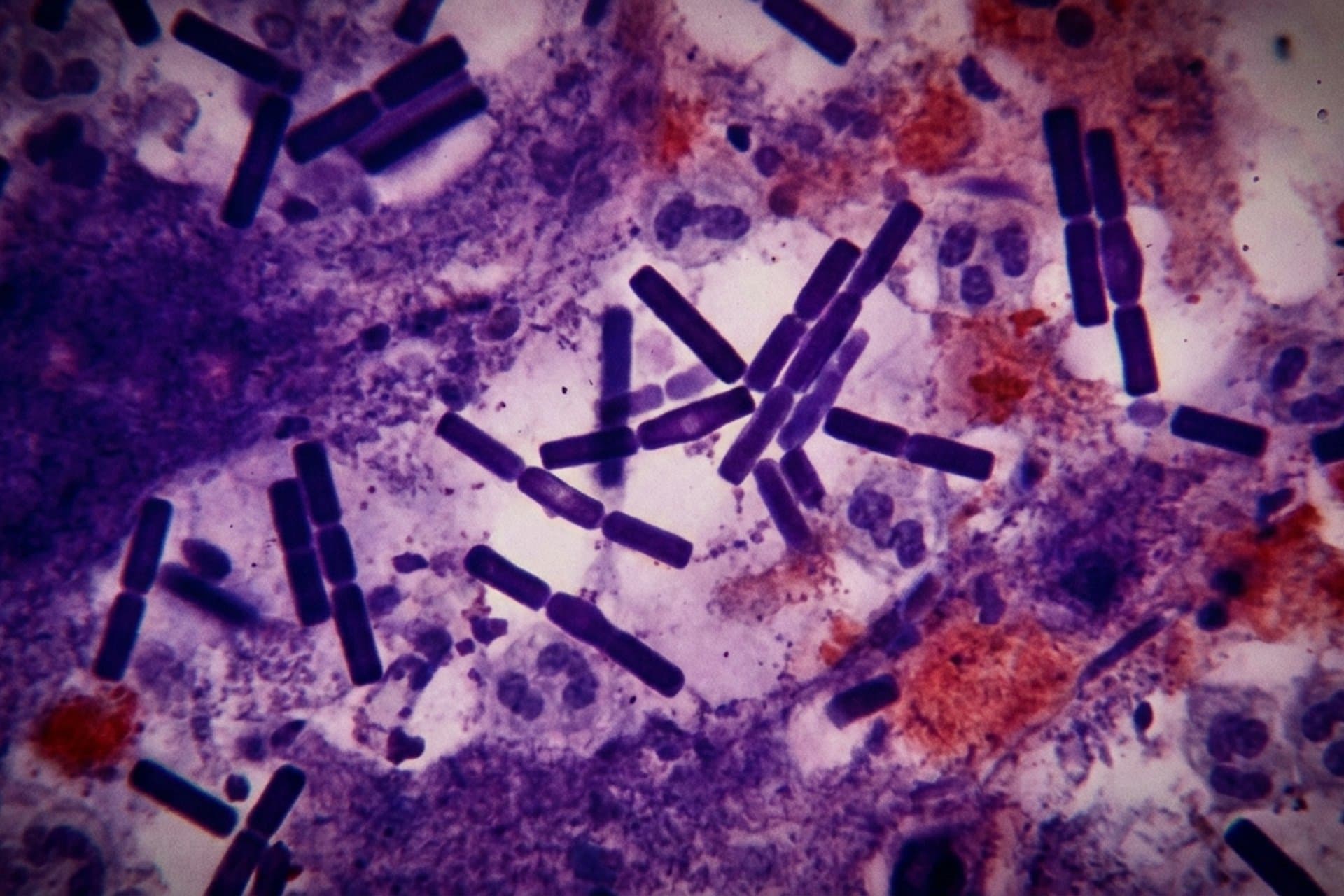 Milzbrandsepsis — medizin.studio