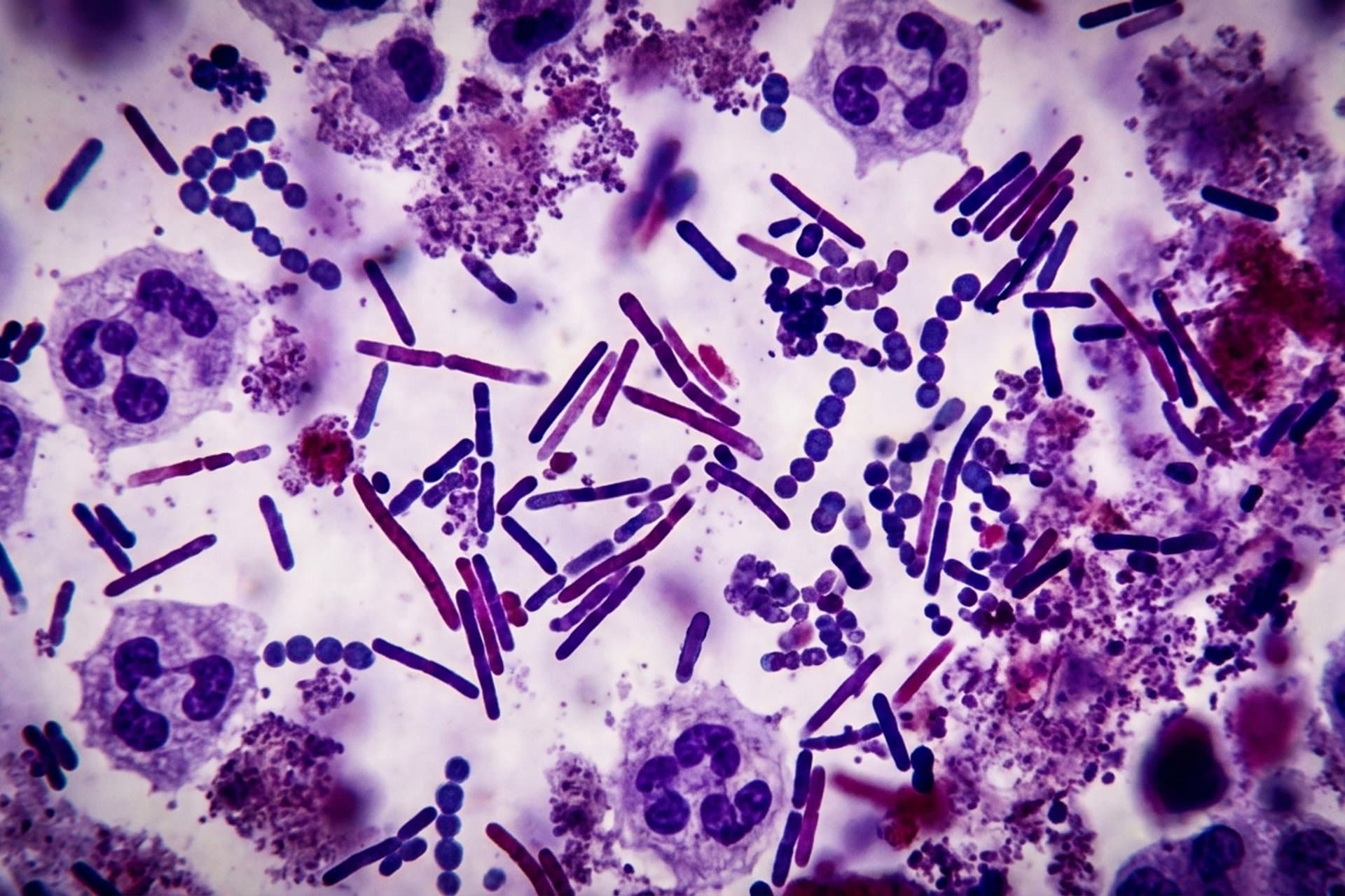 Nekrotisierende ulzerative Stomatitis — medizin.studio