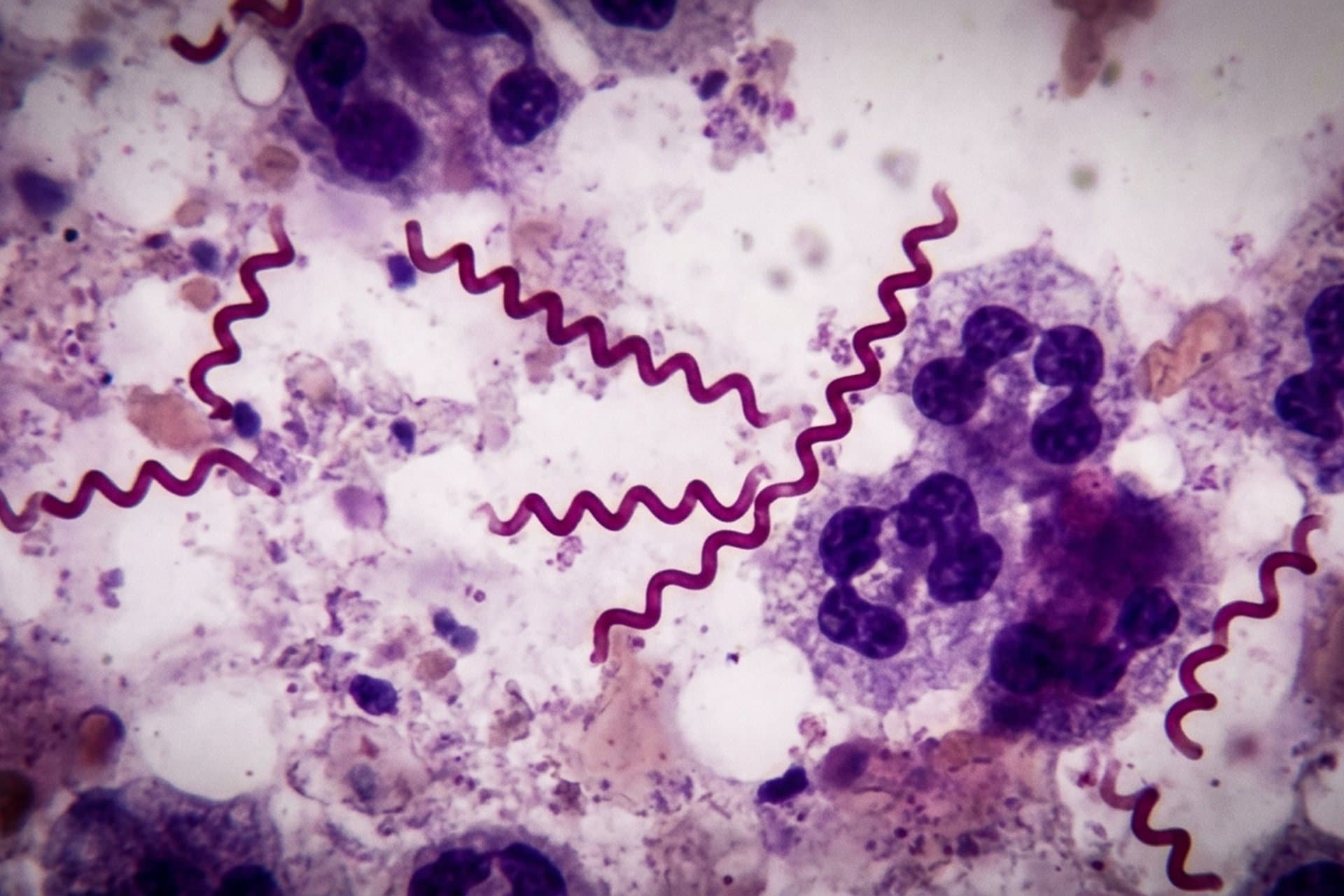 Spätsyphilis — medizin.studio
