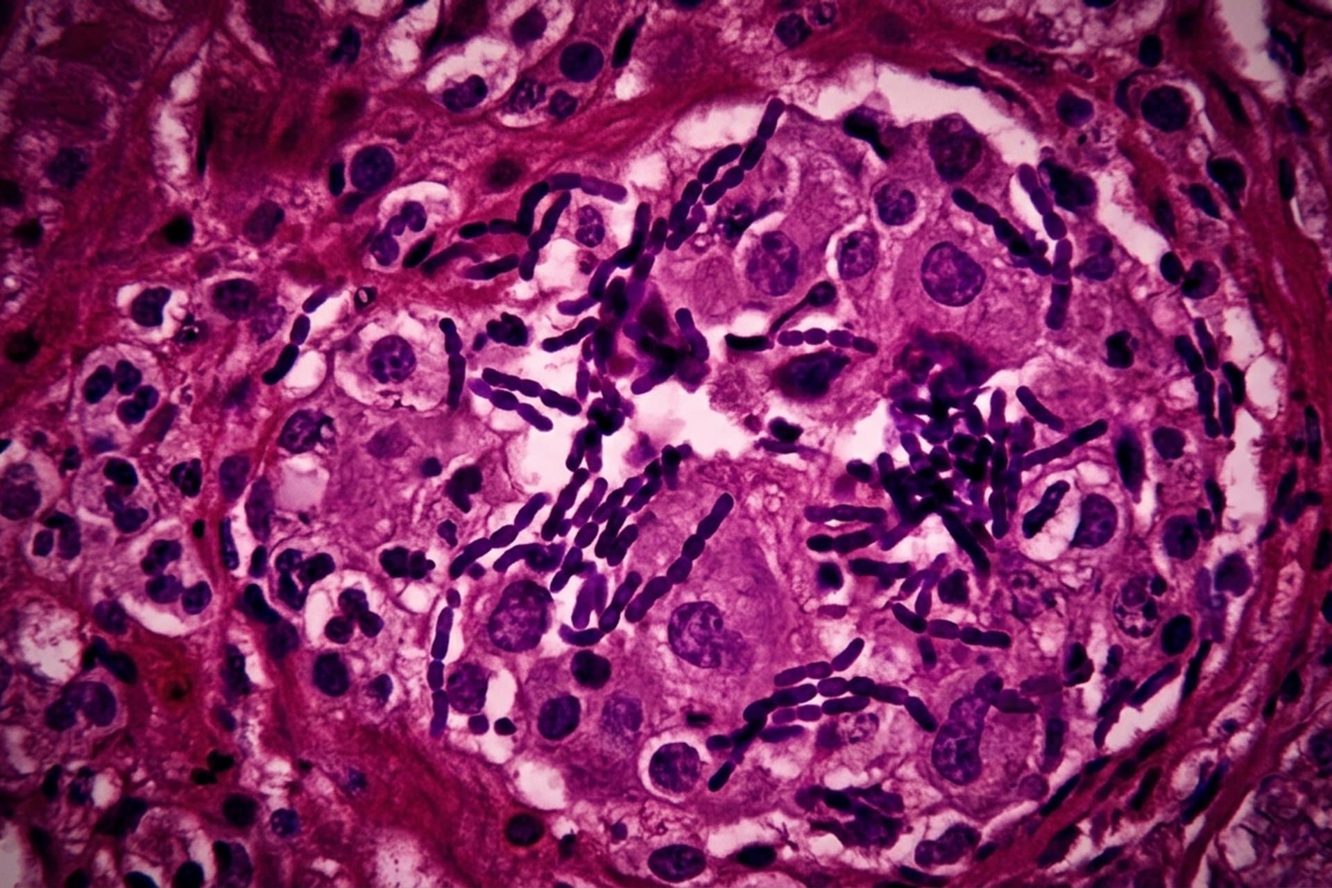Tuberkulose des Darms, des Peritoneums und der Mesenteriallymphknoten — medizin.studio